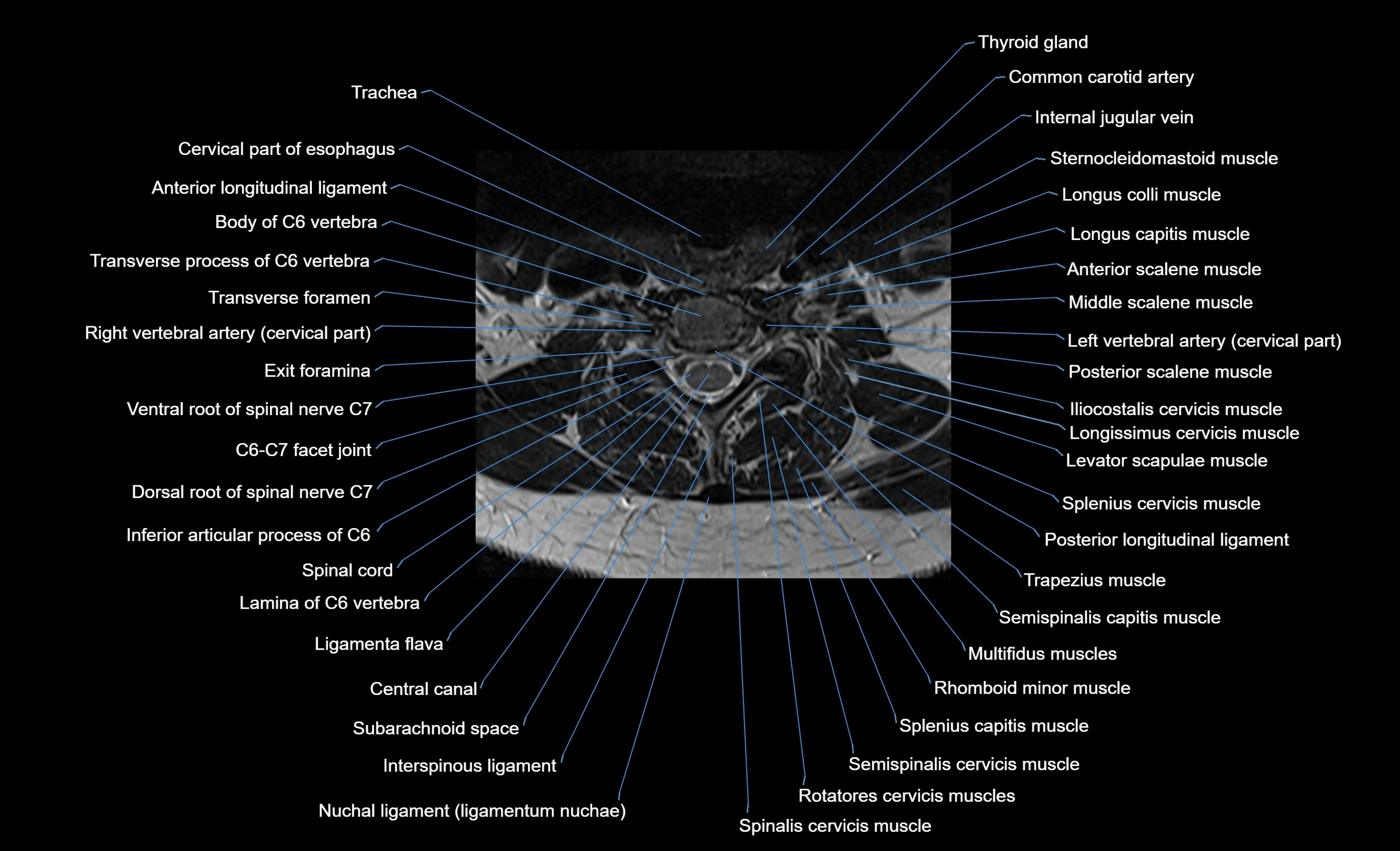 cervical spine cross sectional MRI anatomy  3T MRI axial  image-img-00001-00032.webp